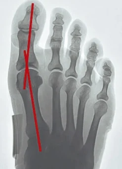 „epitact" Korrekturorthese Hallux-Valgus