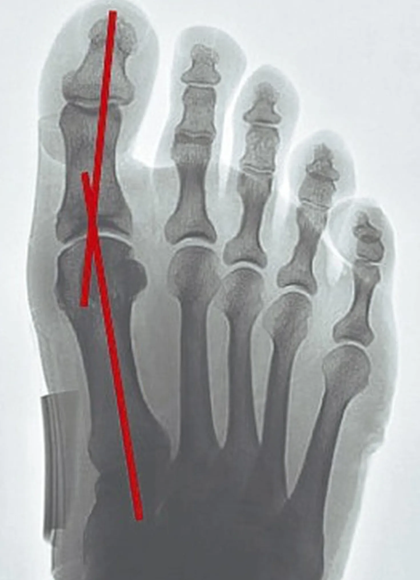 „epitact" Korrekturorthese Hallux-Valgus