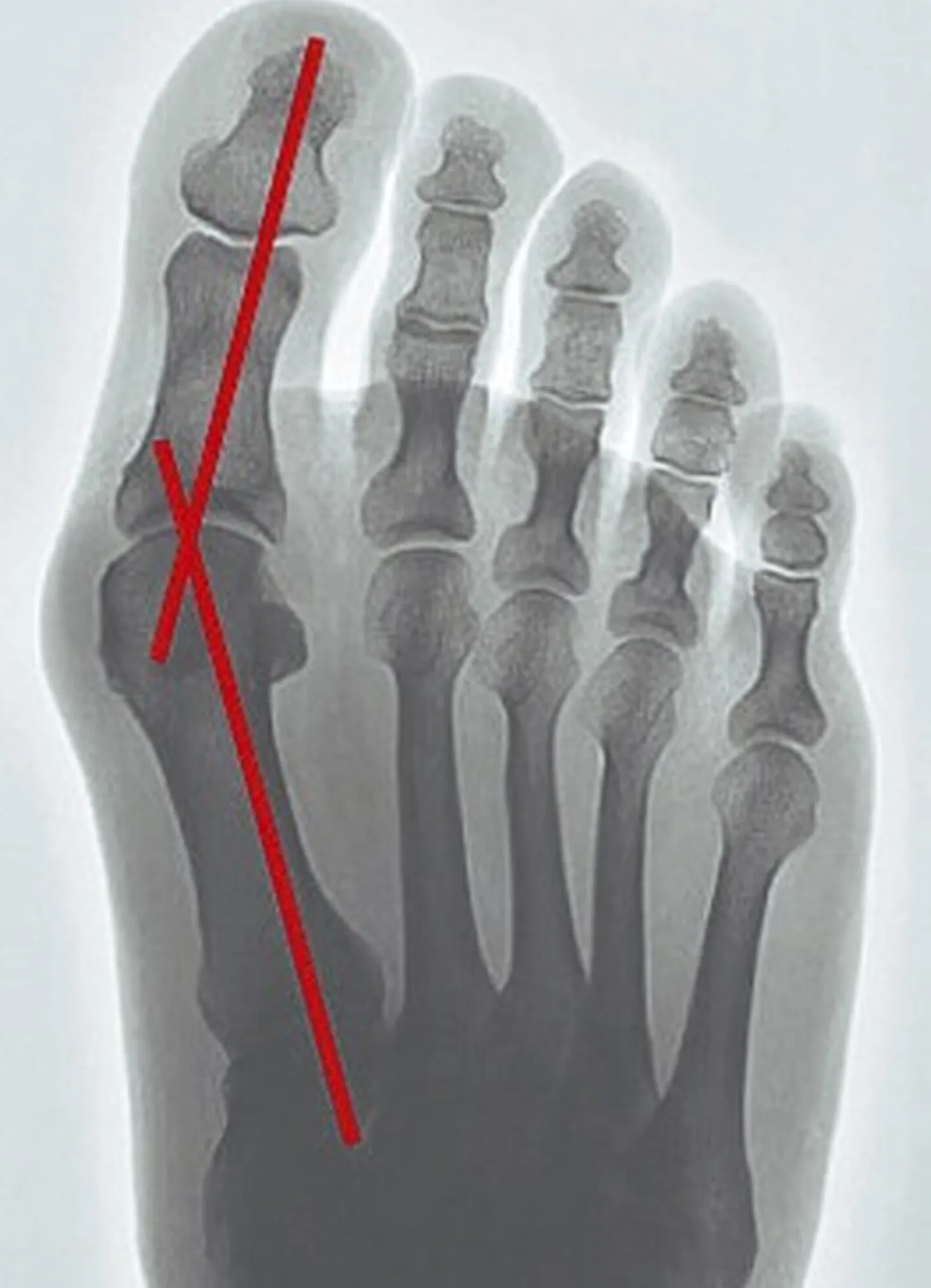 „epitact" Korrekturorthese Hallux-Valgus