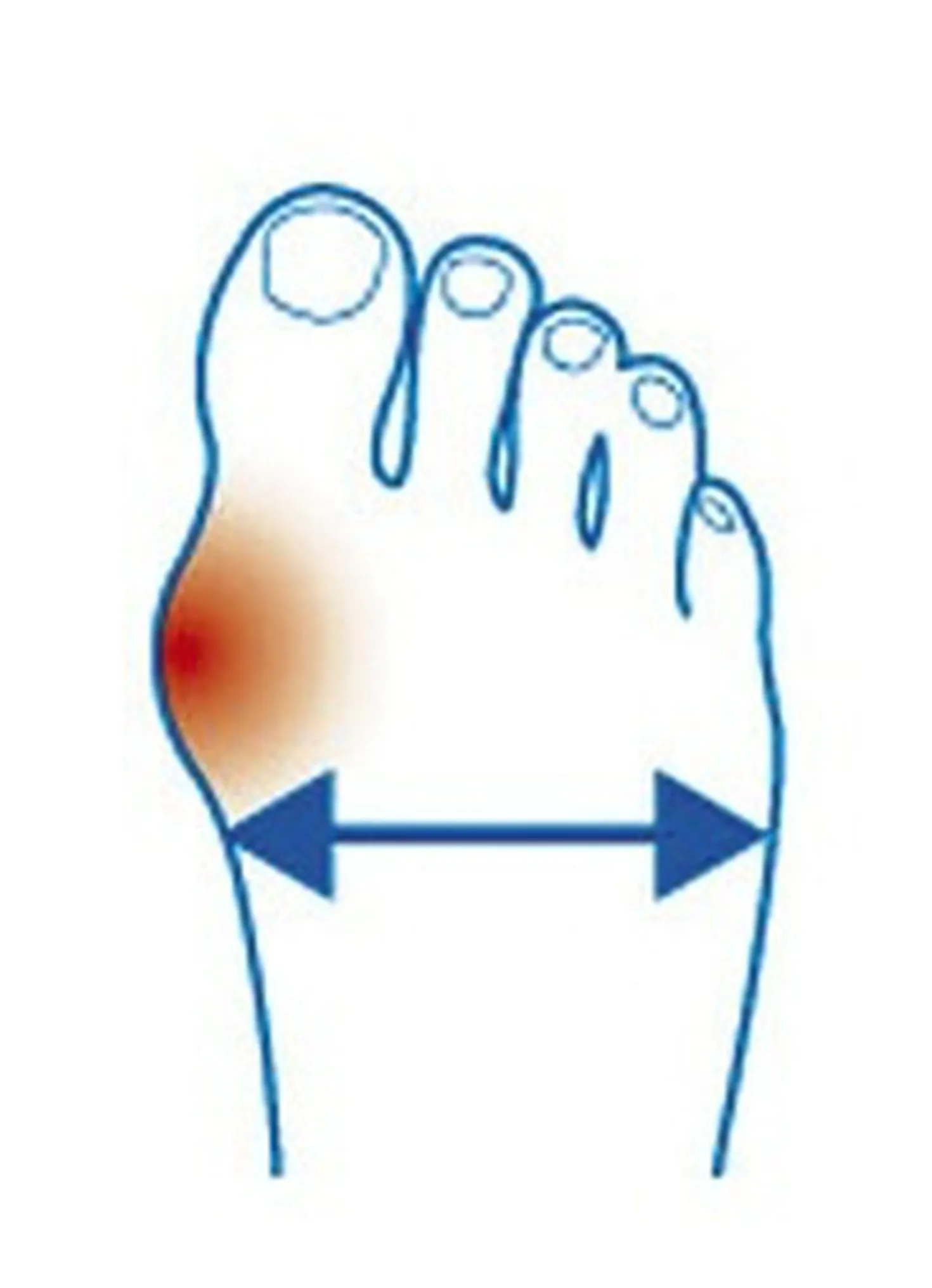 „epitact" Korrekturorthese Hallux-Valgus